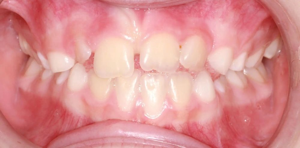 Before treatment, front view