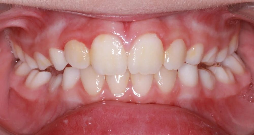 After treatment, front view