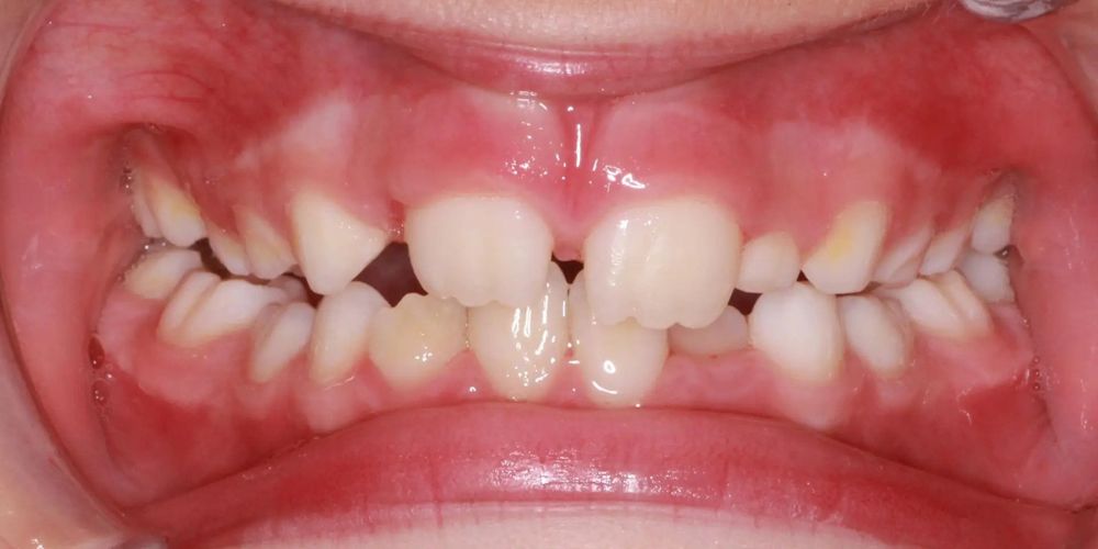 Before treatment, front view