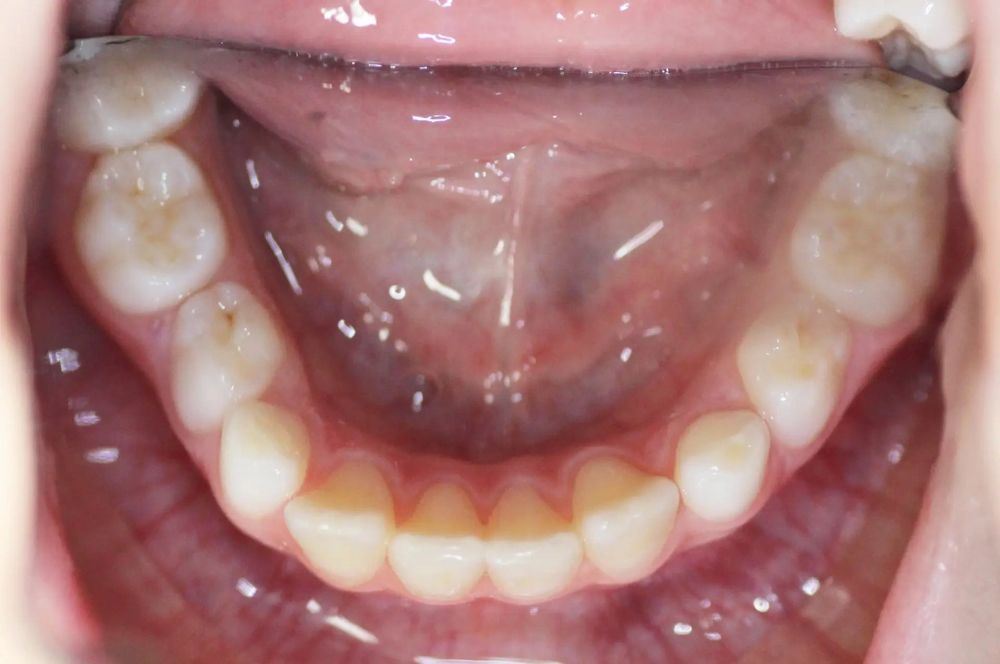 After treatment, lower teeth from above