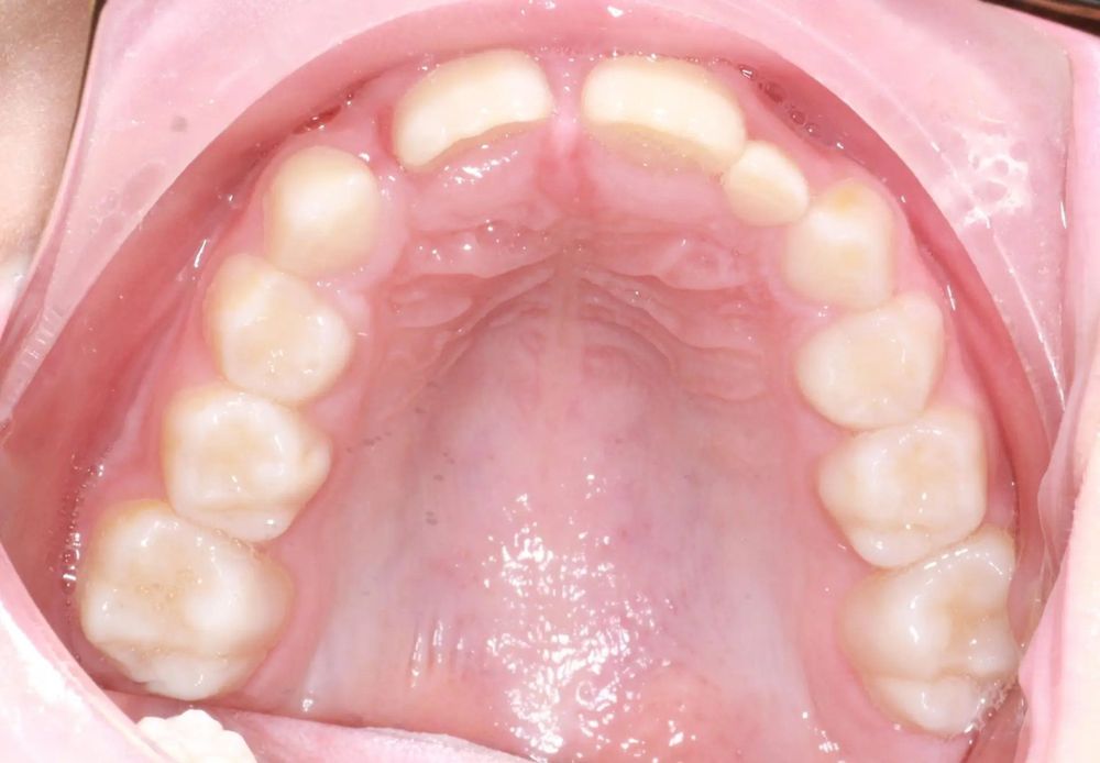 Before treatment, upper teeth from above