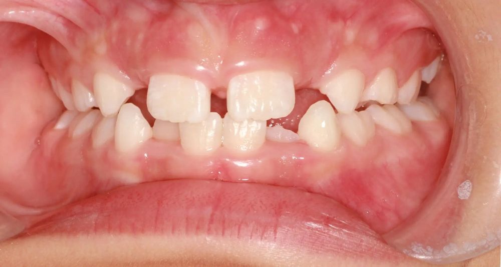 Before treatment, front view