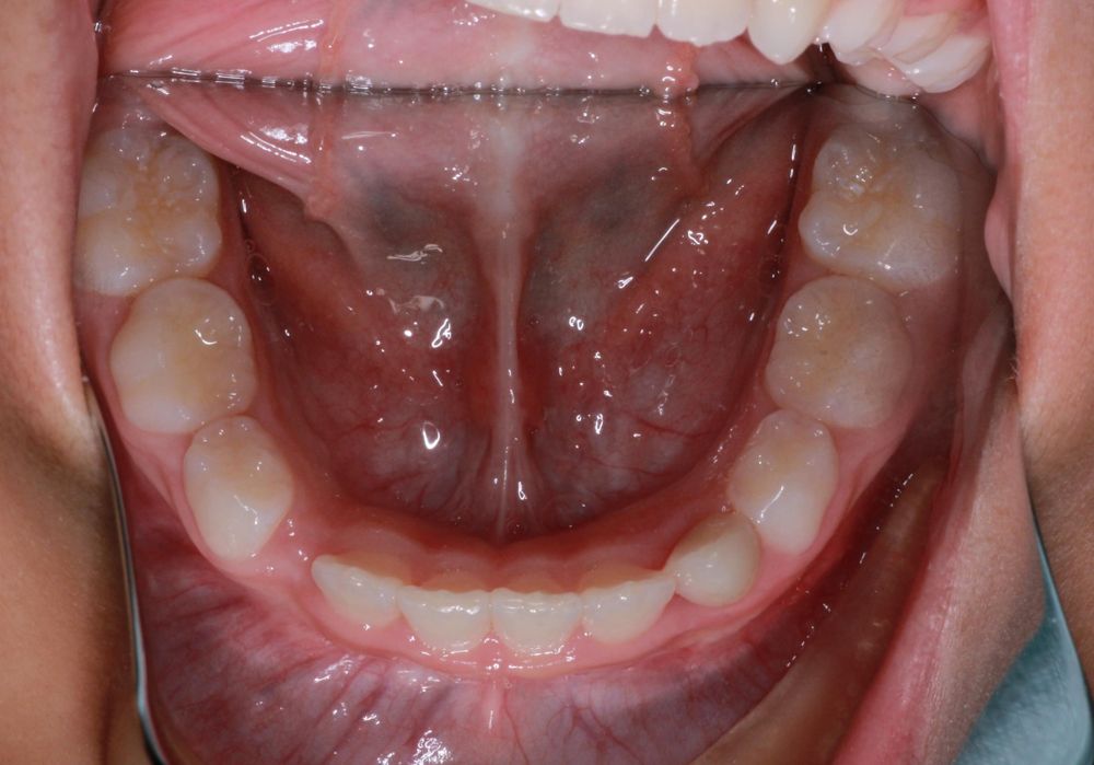 After treatment, lower teeth from above