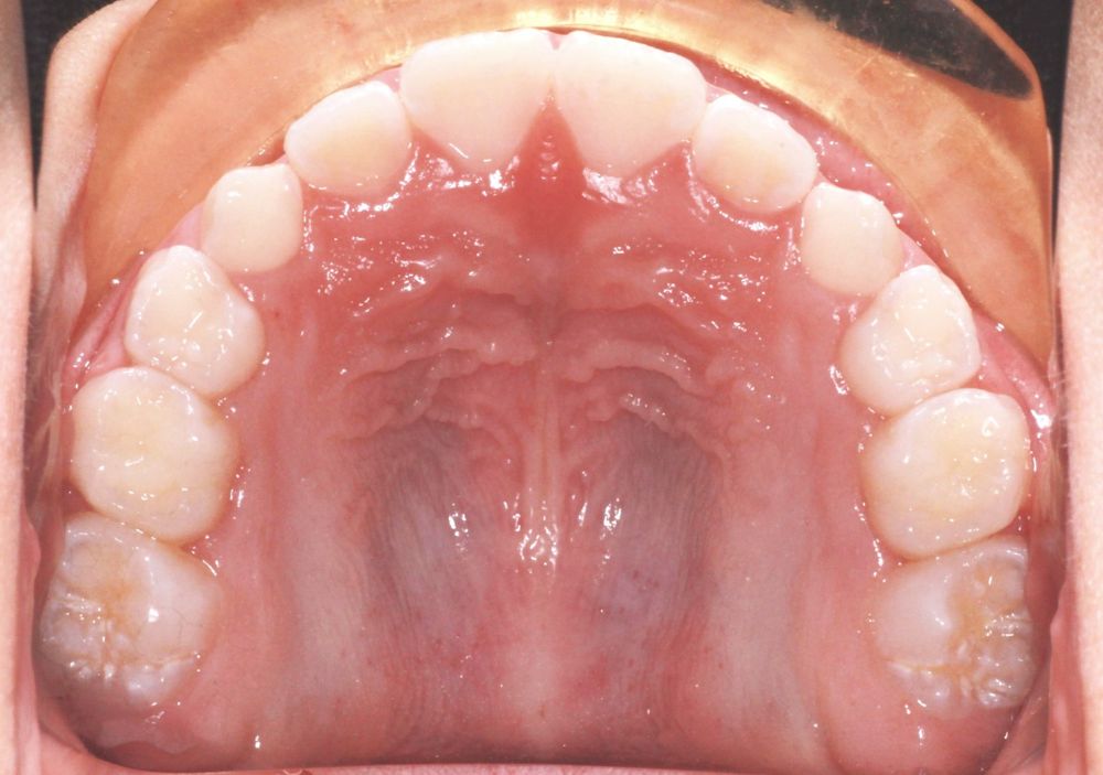 After treatment, upper teeth from above