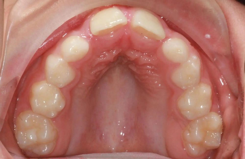 Before treatment, upper teeth from above