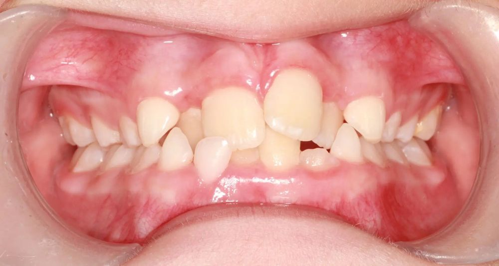 Before treatment, front view