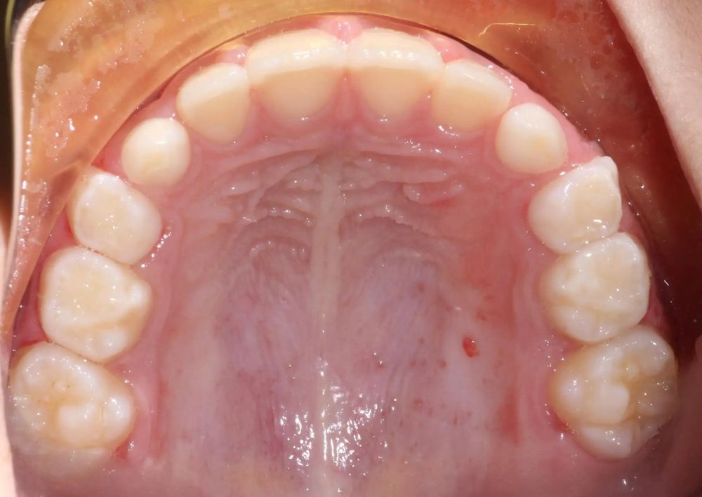 After treatment, upper teeth from above