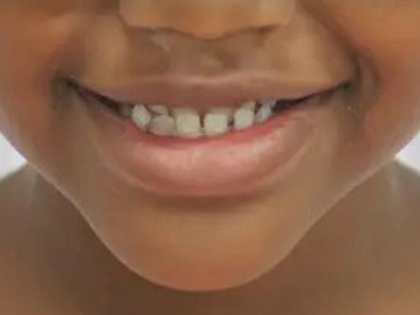 Before treatment, close-up of the smile