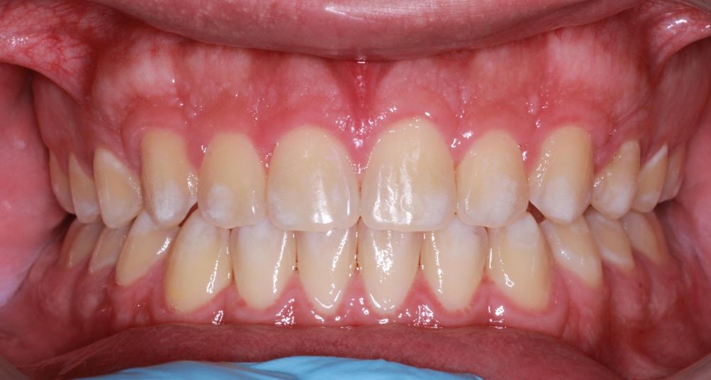 After treatment, front view