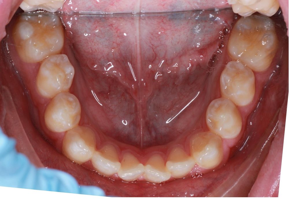Before treatment, lower teeth from above