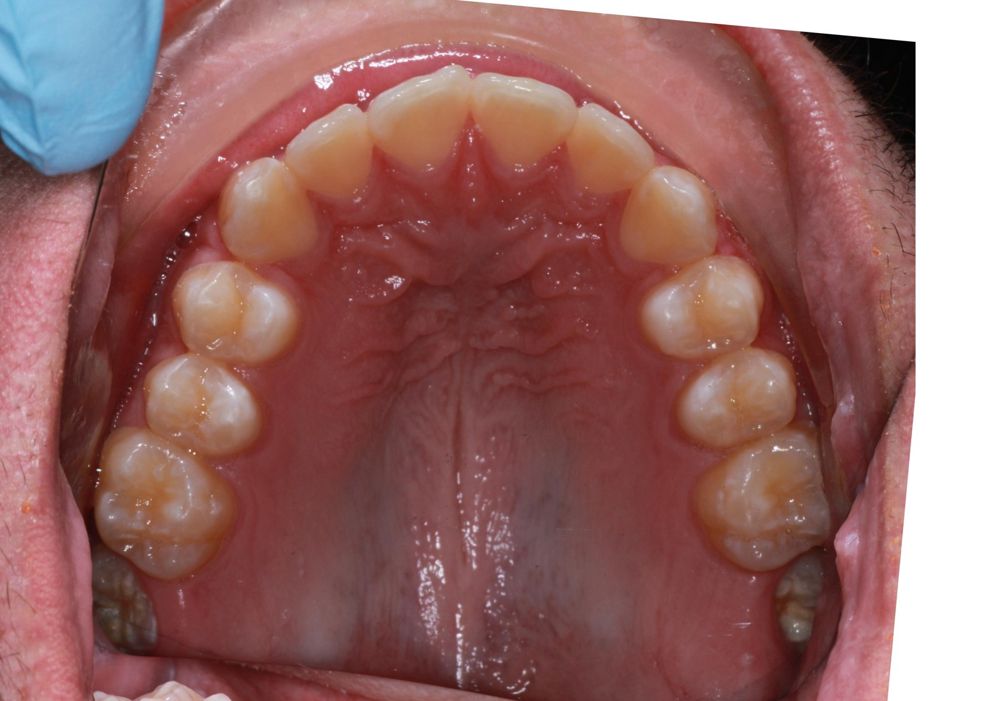 Before treatment, upper teeth from above